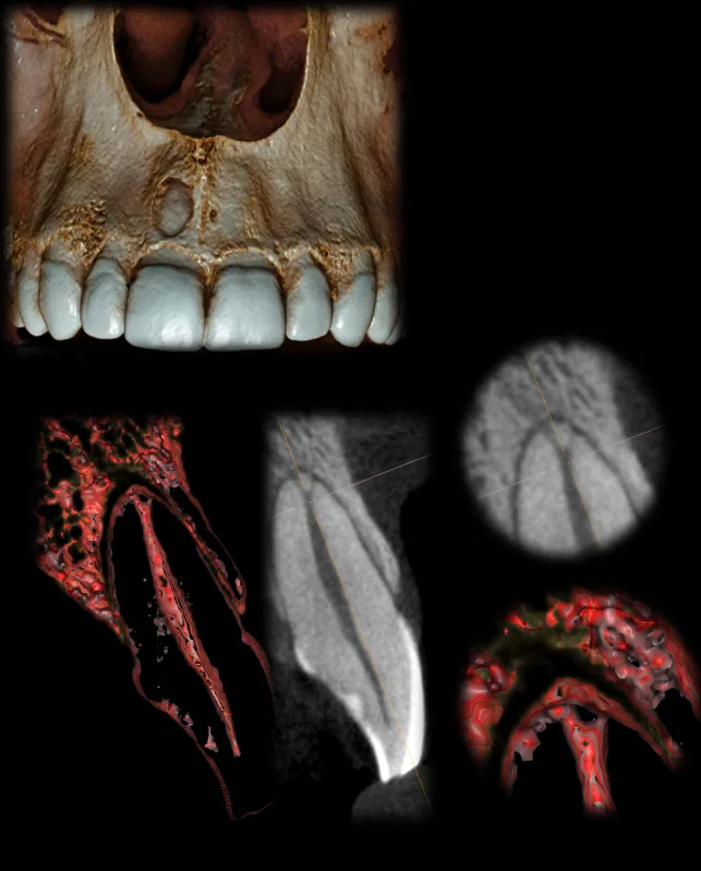 Advanced endodontic CBCT and 3D reconstruction examples