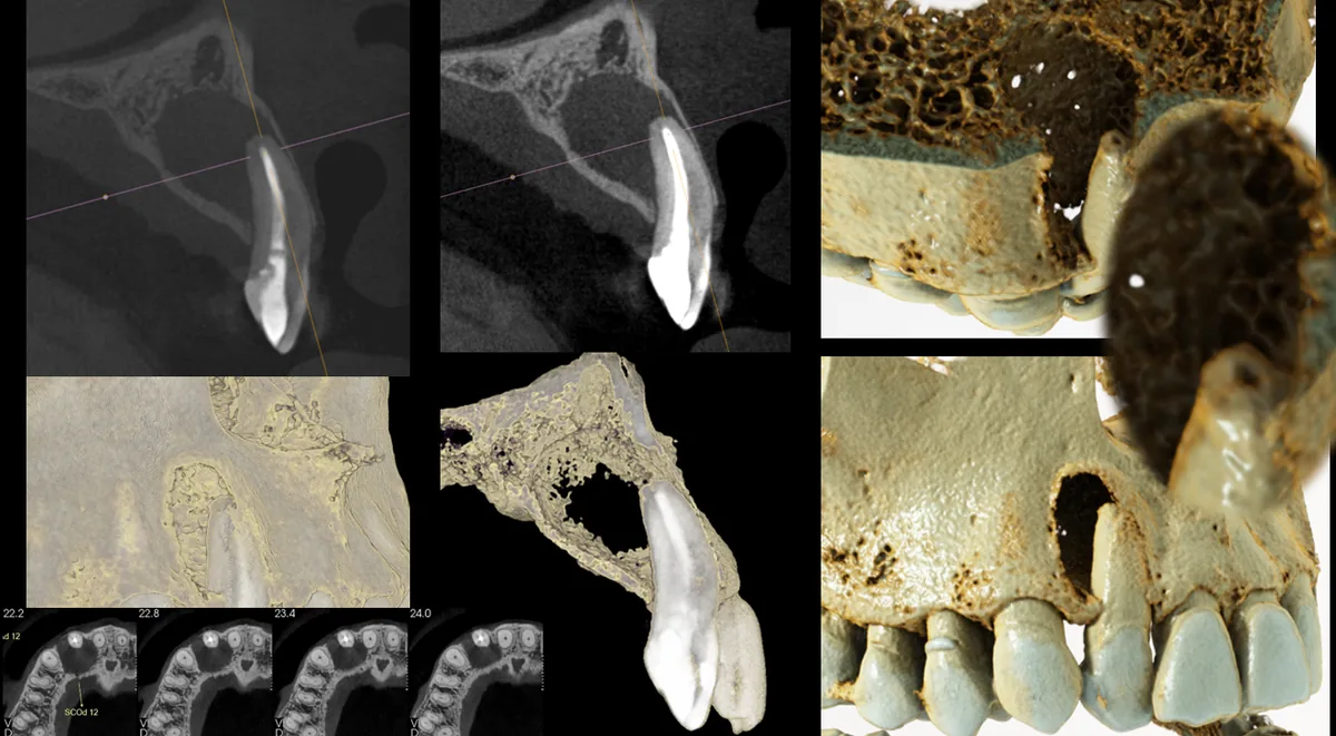 Advanced CBCT imaging and 3D anatomy of the maxilla and maxillary sinus
