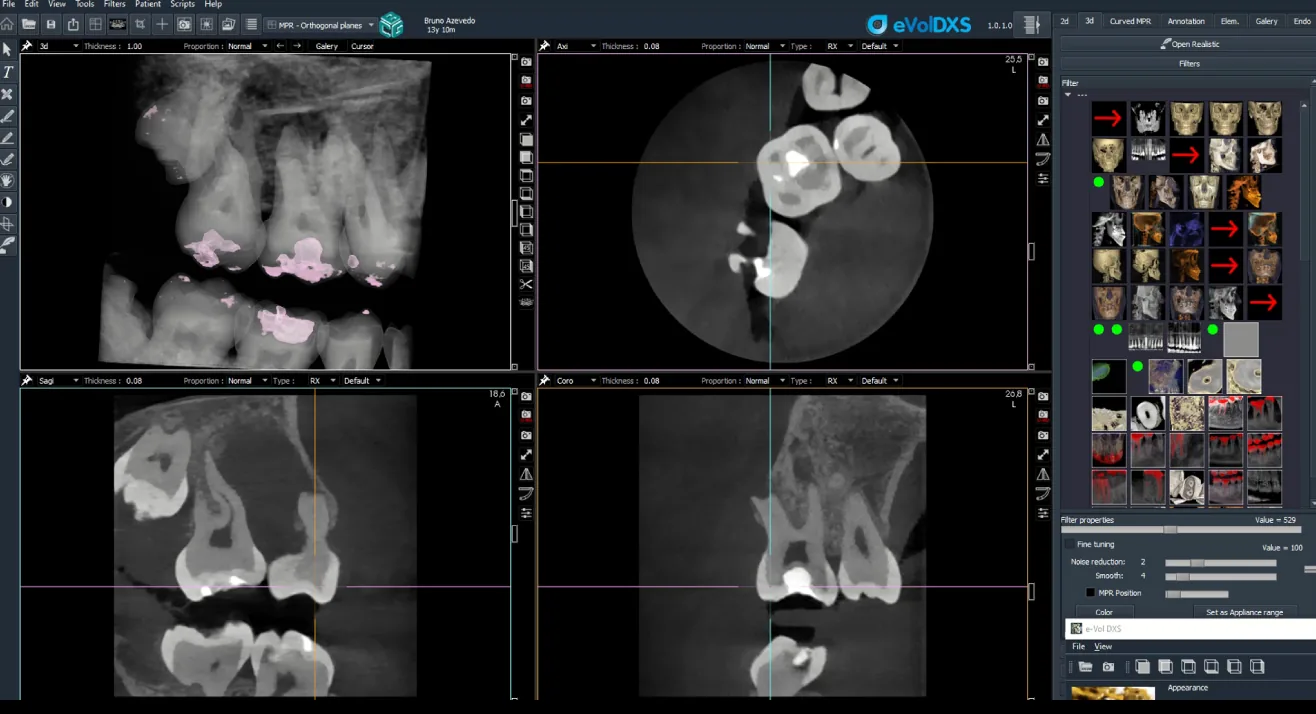 Advanced CBCT interpretation software showing multiplanar dental imaging